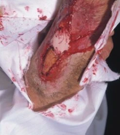 Cicatrice Latex Fracture Os