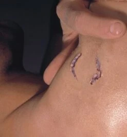 Cicatrice Morsure De Vampire