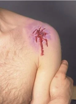 Cicatrice Latex Plaie