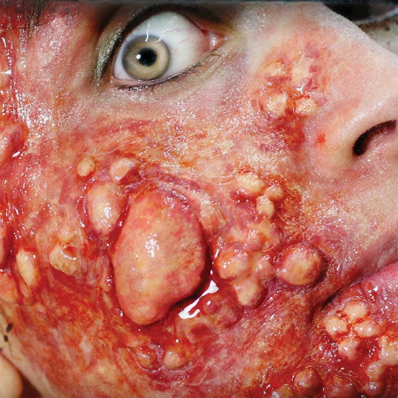 Cicatrice éruptions 2 Cicatrice éruptions – Image 2