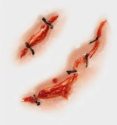 Cicatrice Fx Transferts 3d Points De Suture 2 Cicatrice Fx Transferts 3d Points De Suture – Image 2